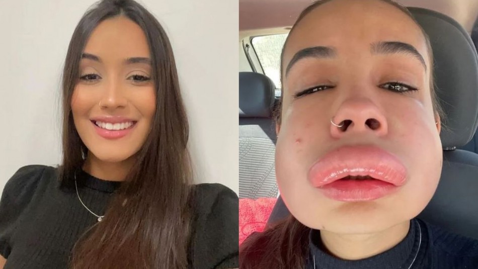 joven-estuvo-a-punto-de-morir-tras-una-fallida-sesion-de-relleno-de-labios Una joven estuvo a punto de morir tras una fallida sesión de relleno de labios en Brasil.
