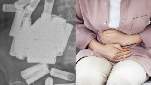 Fue al doctor por dolores abdominales y le terminaron extrayendo 55 pilas de su estómago e intestino