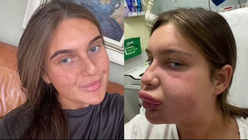 'Sentía que iban a estallar': Joven sufre severa reacción alérgica después de disolverse el relleno de sus labios