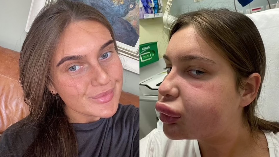 Una joven sufrió severa reacción alérgica después de disolverse el relleno de labios.