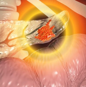 Podría provocar diabetes: Estos son 8 síntomas del cáncer de páncreas Podría provocar diabetes: Estos son 8 síntomas del cáncer de páncreas