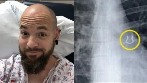 Fue al médico por una fuerte tos y descubrió que tenía un piercing en un pulmón: Lo había perdido hace cinco años