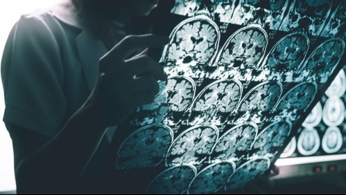 Por primera vez un fármaco experimental logra disminuir el deterioro cognitivo del alzhéimer