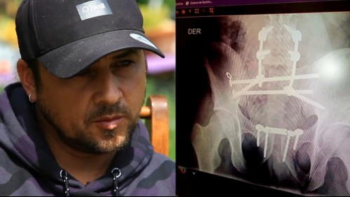 'Me impactaron de frente': Logró sobrevivir tras ser impactado por vehículo que corría en carrera clandestina