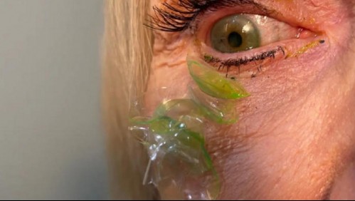'Nunca había visto algo así': Extraen 23 lentes de contacto en el ojo de una paciente que olvidó quitárselos