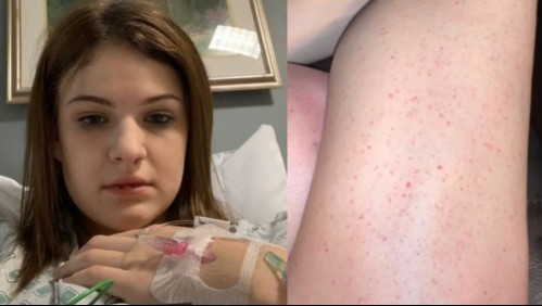 Joven pensó que el sarpullido en sus piernas era inofensivo, pero 'estaba a minutos de la muerte'