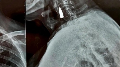 Veterano de guerra se somete a radiografía y descubre que tenía una bala incrustada en su cuello