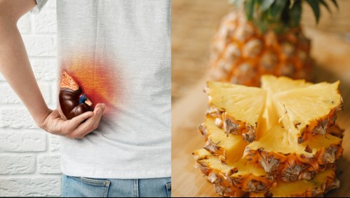 ¿Sirve la piña para los cálculos renales? Experto de la Universidad de Chile explica cómo puedes prevenirlos