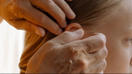 ISP emite alerta por 'efectos indeseados' en reconocido medicamento usado para el tratamiento de piojos y sarna