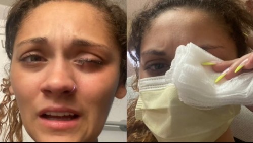 'Un horrible dolor': Joven confundió gotas para los ojos con pegamento y sus párpados quedaron sellados