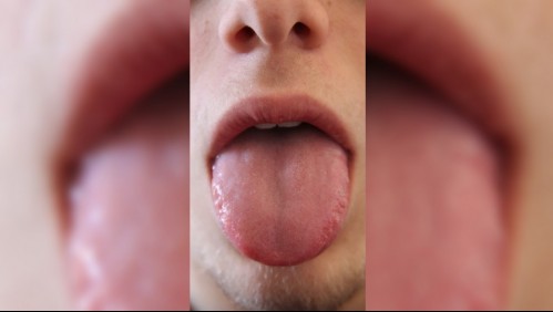 ¿Se te agrietó la lengua? Estas son las enfermedades que podrían estar relacionadas
