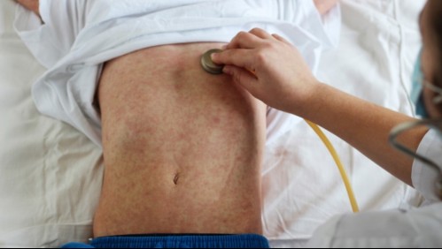 Millones de niños en riesgo: Estos son los síntomas del sarampión, el virus por el que la OMS levantó una alerta