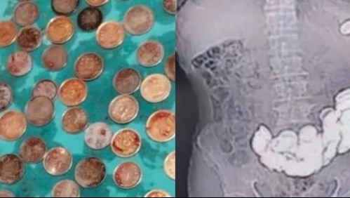 Lo llevaron a urgencias por un fuerte dolor abdominal y encontraron un 'tesoro' dentro de su estómago