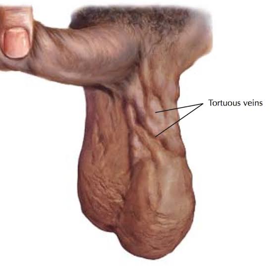 Ilustración de venas varicocele.  Créditos Twitter @kwesi_bimpe