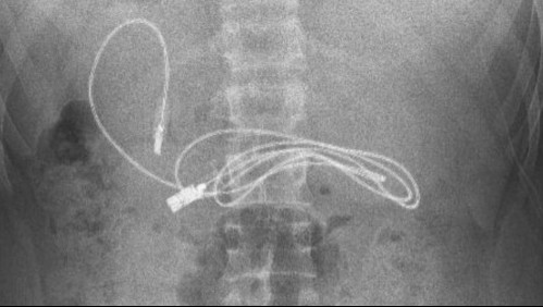 Lo llevaron a urgencias por dolor de estómago y encontraron un cable USB dentro de su colon