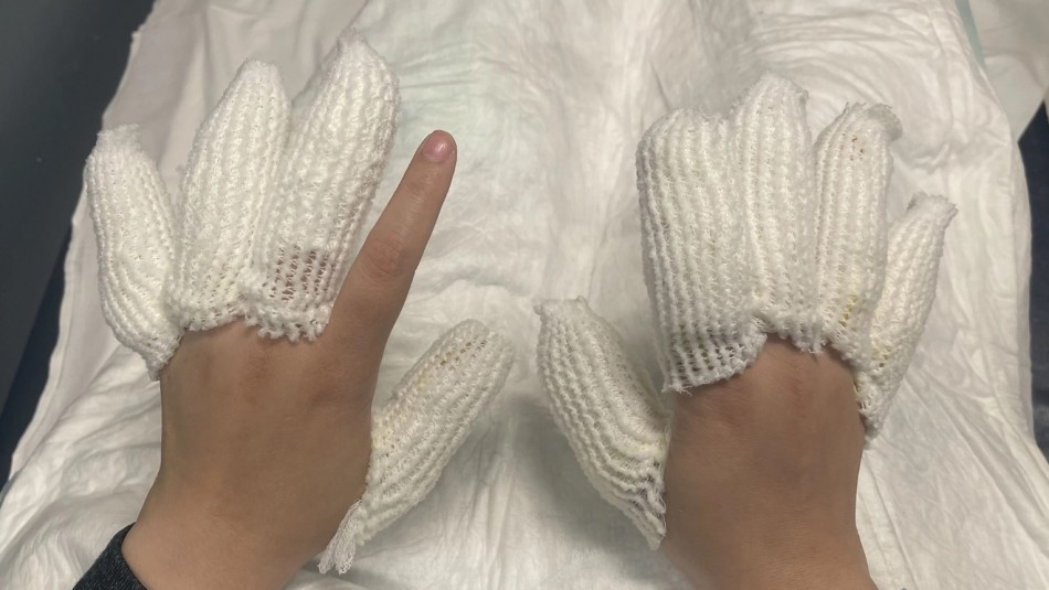 La joven con sus dedos quemados / NY Post