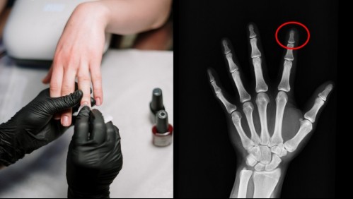 ¡Fue a embellecer sus uñas naturales!: Manicurista las confundió con uñas acrílicas y ahora puede perder un dedo