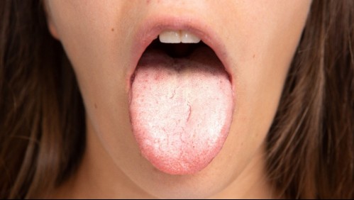 ¿Se te puso la lengua blanca? Estas son las posibles causas de esta habitual afección