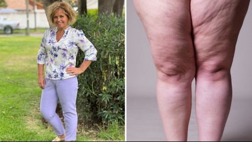 La chef Paula Larenas fue diagnosticada con lipedema: Así puedes diferenciarlo de la obesidad