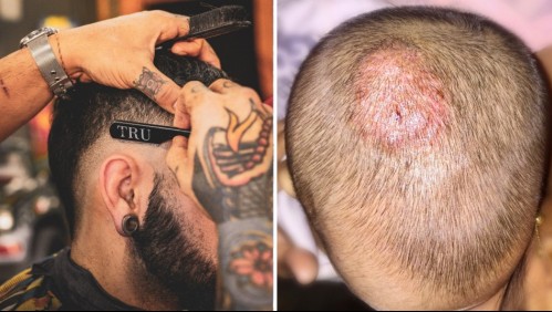 Detectan brote de tiña en España: ¿Por qué las peluquerías serían responsables de las infecciones?