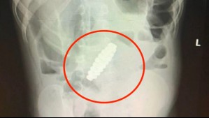 Llevaron a su hijo al doctor por una posible apendicitis, pero tenía un extraño objeto en sus intestinos