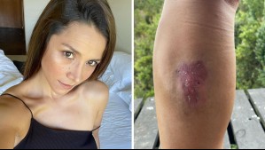 Loreto Aravena casi necesitó injerto de piel: Estas son las complicaciones tras la picadura de araña de rincón