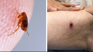 ¿Es peligroso el 'tifus de los matorrales'?: Estos son los síntomas de la enfermedad que aumenta en Los Lagos