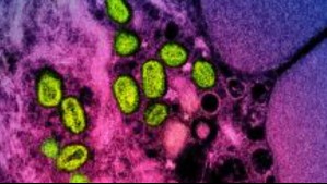 'Mpox fulminante': Científicos identifican nuevo y peligroso tipo de 'viruela del mono'