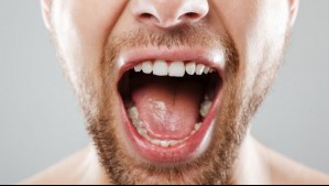 Podría ser un síntoma de cáncer: Revisa los cambios en tu boca a los que debes estar atento