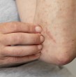 Psoriasis, depresión y ansiedad: ¿Cómo afecta la enfermedad de la piel a la salud mental? Psoriasis, depresión y ansiedad: ¿Cómo afecta la enfermedad de la piel a la salud mental?