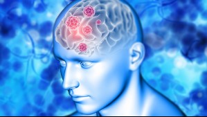 Tumor cerebral: Estos son 5 extraños síntomas que se pueden presentar