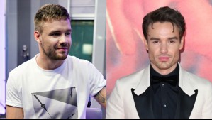 Liam Payne se la habría realizado: Esta es la razón por la que los expertos no recomiendan la bichectomía