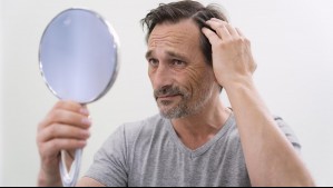 Al 60% de los pacientes se les manifiesta antes de los 20 años: Conoce cómo se comporta la alopecia en hombres y mujeres