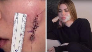 Pensó que era una espinilla: Cómo identificar un melanoma como el que tuvo Khloé Kardashian