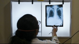 Tras detectarse un caso de tuberculosis en La Florida: ¿Esta enfermedad no estaba erradicada?