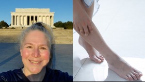 Mujer fue al médico por una picazón entre los dedos del pie y terminó siendo diagnosticada con una rara enfermedad
