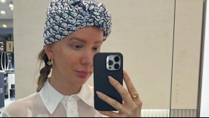 'Moretones por todas partes': Aylén Milla comparte las consecuencias que dejan las quimioterapias en su cuerpo