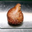En Sri Lanka extirparon a un paciente de 62 años el cálculo renal más grande y más pesado registrado hasta ahora. El sargento en retiro Canistus Coonge tenía una piedra de 801 gramos.