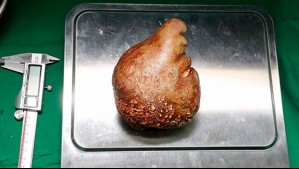 Extirpan a paciente de 62 años el cálculo renal más grande y más pesado de la historia