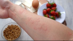 Alergias alimentarias: ¿Qué son y cómo podemos detectarlas?