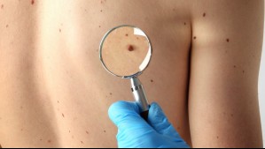 ¿Qué son los lunares de carne y cómo se pueden tratar?