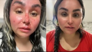 'Me explotó en la cara': Influencer chilena relata momento en que se quemó su rostro al abrir una olla a presión