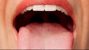 Estos son 9 síntomas que advierten sobre el cáncer de lengua
