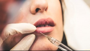 Duración del botox en el rostro disminuyó tras la pandemia: ¿Cuáles son las razones?