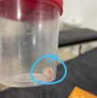 Médicos del Hospital Regional de Encarnación, en Paraguay, descubrieron que la causa de una tos crónica que aquejó a una menor de edad se debió a la presencia de una tapa de pasta de dientes en sus vías respiratorias.