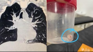 Niña tuvo tos por más de 20 días y descubrieron que tenía una tapa de pasta dental en sus vías respiratorias