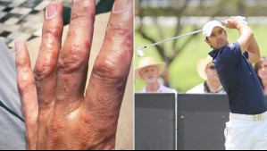 'Tengo mucho susto': Este es el doloroso virus que afecta al golfista chileno Benjamín Alvarado