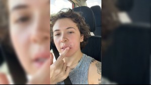 'No volveré a hacerlo en la vida': Mujer se reventó un grano en la cara y terminó con una dolorosa infección
