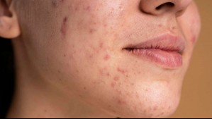 Espinillas en la cara: ¿Qué relación tendría la aparición de acné con nuestra salud?