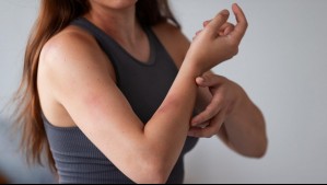 Incontinencia en la piel: Una dermatitis más común de lo que se piensa